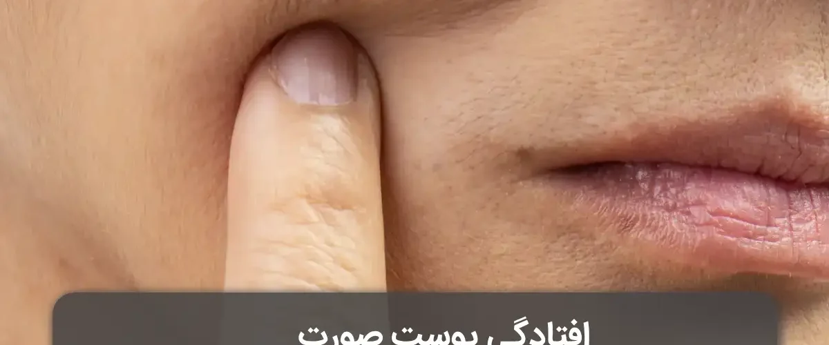 افتادگی پوست صورت